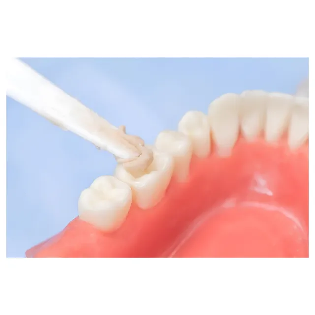Huge Filling I Cam İyonomer Dolgu 4